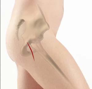 Mini-Posterior and Direct Superior Approach Total Hip Replacement