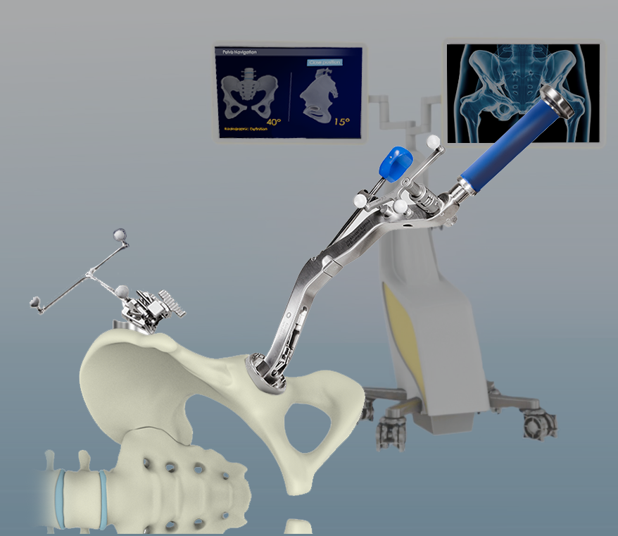 Computer Navigated Hip Replacement