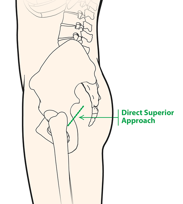 Direct Superior Hip Replacement