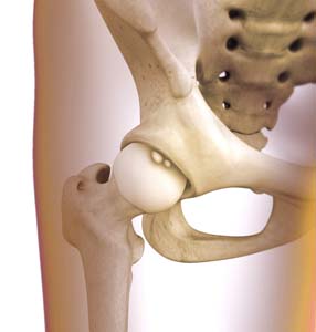 Snapping Hip Syndrome