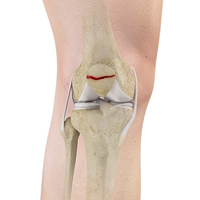 Fractures of the Patella