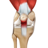 Patellar Tendinitis