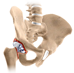 Complex Revision Total Hip Replacement Surgery