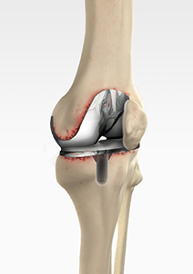 Revision Total Knee Arthroplasty